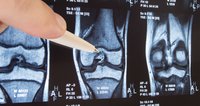 Knee osteoarthritis treatment delivers Regeneus a A$1.6M milestone payment